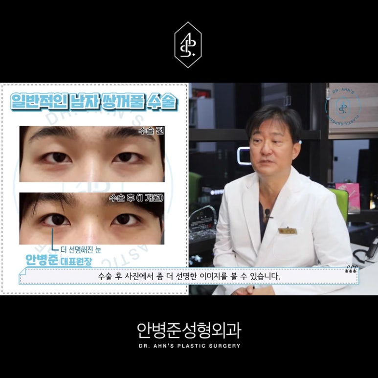 [남자성형외과] 남자 눈성형 쌍꺼풀수술 사례 모음 관련 이미지 2