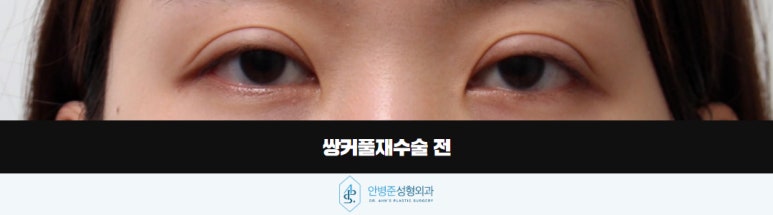 쌍꺼풀재수술 잃어버렸던 자연스러운 눈을 찾아서 관련 이미지 2