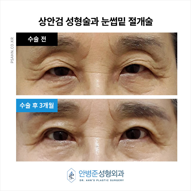 [방배역성형외과] 처진 눈꺼풀 피부를 해결하는 수술? 관련 이미지 2