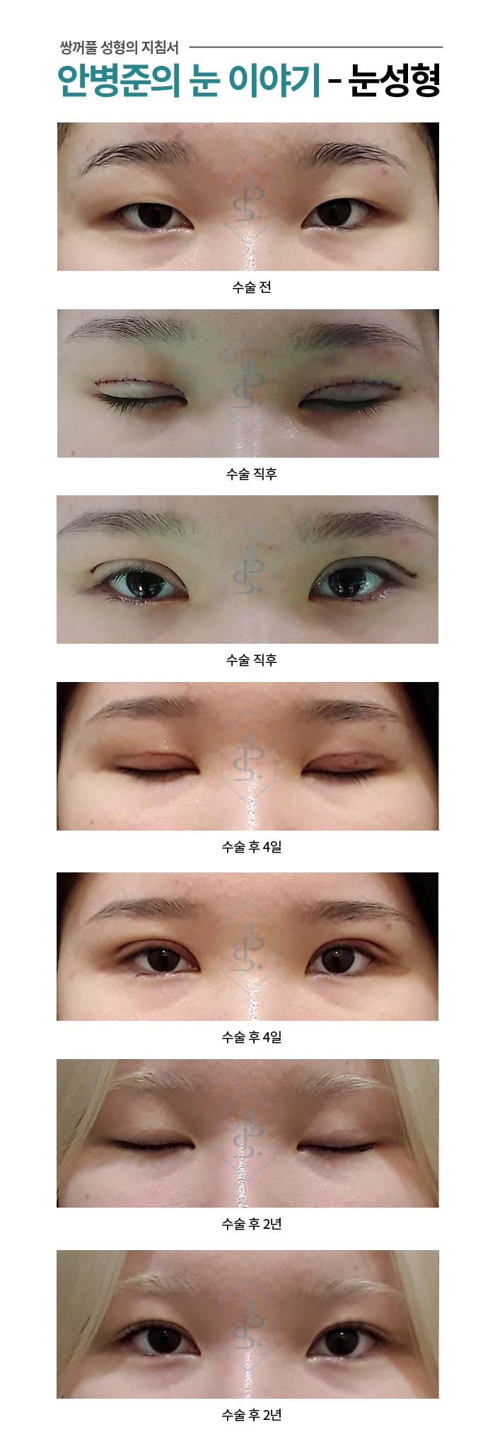 [방배역성형외과] 가짜 안검하수와 진짜 안검하수 관련 이미지 1