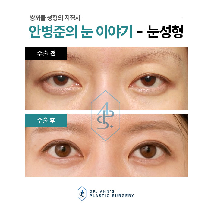 [방배역 성형외과] 꺼진 윗눈꺼풀 - 쌍꺼풀 수술 설명 관련 이미지 1