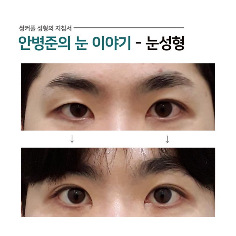 짝짝이 눈(짝눈,재수술) 관련 이미지 1