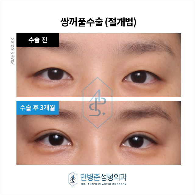 [강남성형외과] 쌍꺼풀수술 정보 - 절개법 수술사례 관련 이미지 1