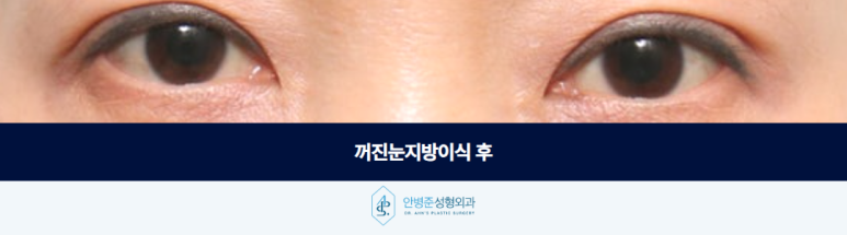 꺼진눈지방이식 눈 위가 꺼져 보인다면 구조부터 살펴야 합니다 관련 이미지 3