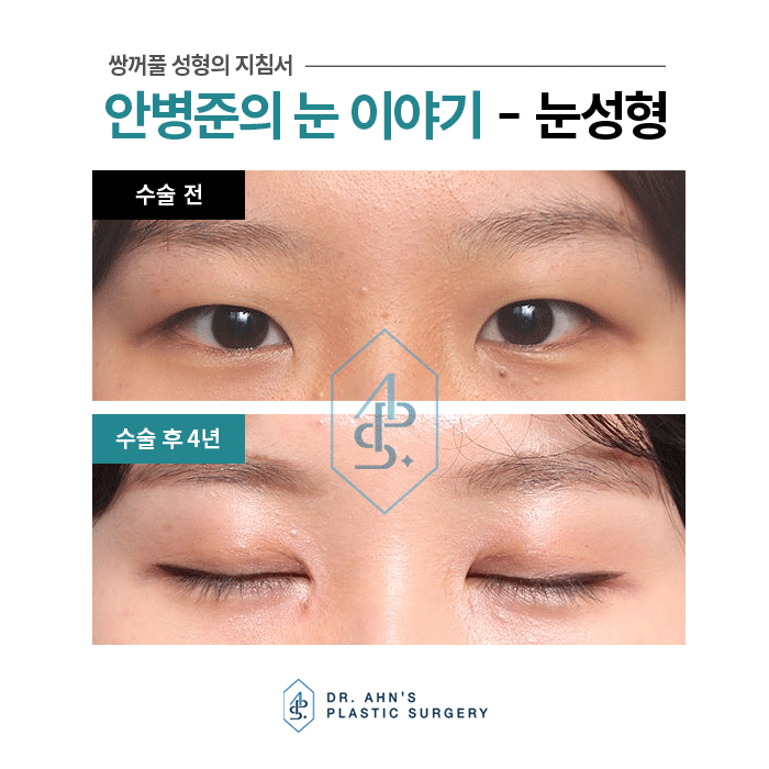 눈꺼풀과 눈두덩이가 두껍다? 피부저침? 절개법! 관련 이미지 4