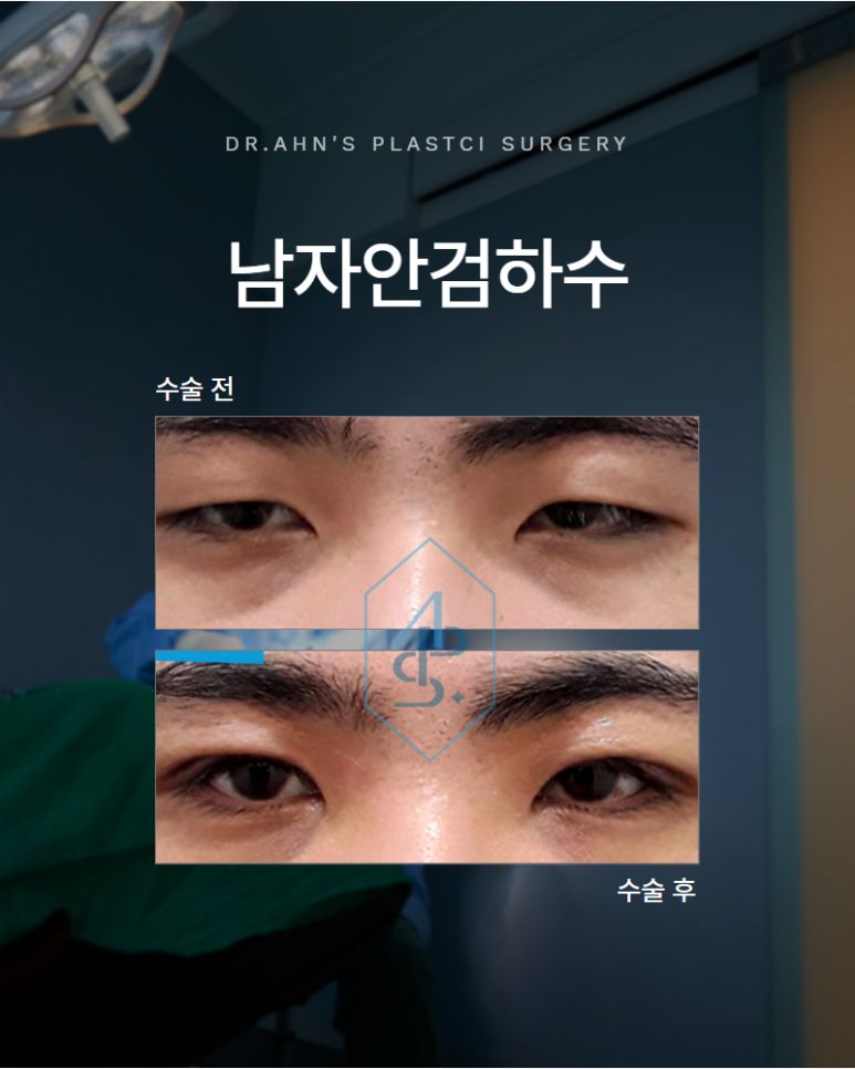 남자안검하수 눈이 처진 것 같다면 확인해야 할 것이 있습니다 관련 이미지 1