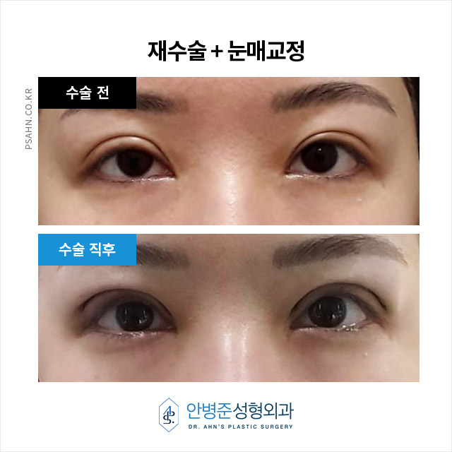 [눈재수술]  두 번의 눈 재수술, 4년간의 관련 이미지 1