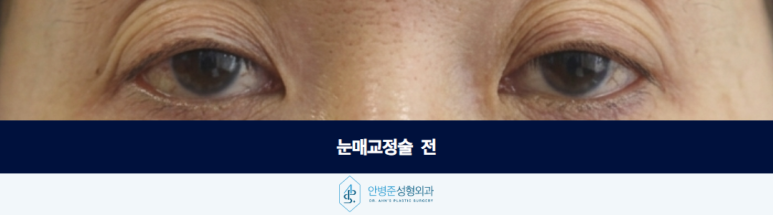 눈매교정술 눈이 잘 안 떠진다면 먼저 확인해야 할 것이 있습니다 관련 이미지 2