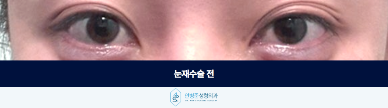 If you want the desired results from double eyelid revision surgery, you have to start over with the design image 2