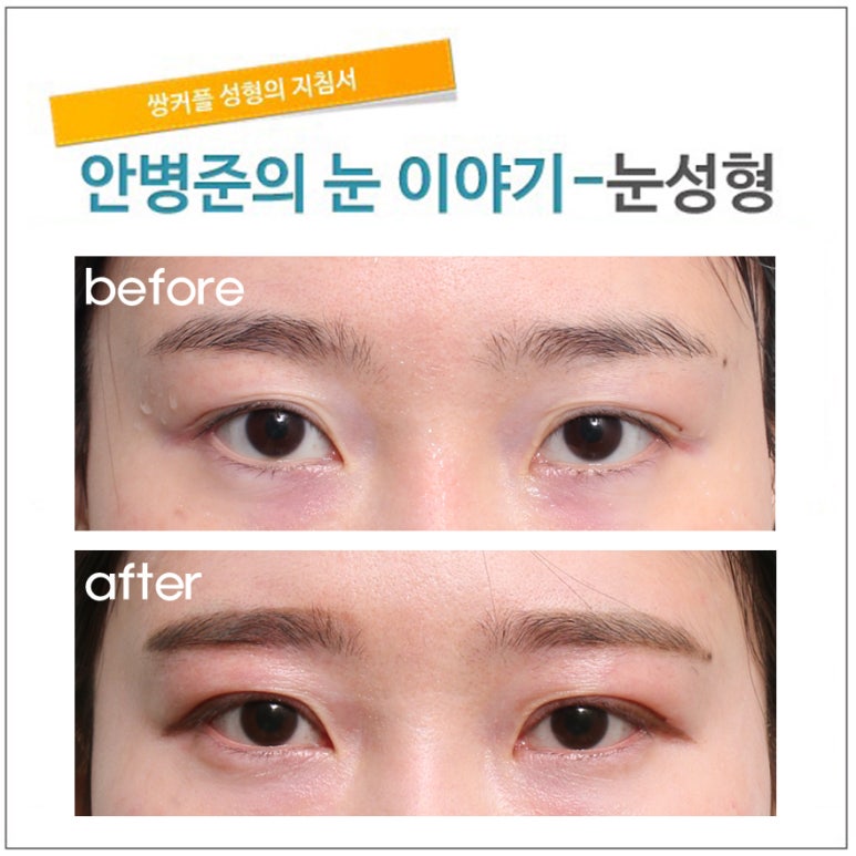 겹주름 관련 이미지 1