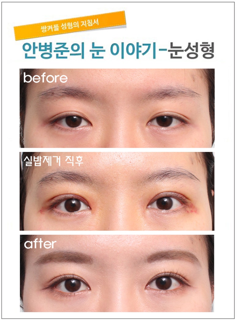 지방이식 없이 꺼진눈 보완(꺼진눈,꺼진눈수술) 관련 이미지 1