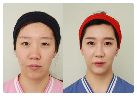 -쌍꺼풀 수술은 왜 하려하는가??-        [안병준의 눈이야기] 관련 이미지 2