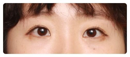 쌍꺼풀,눈매교정 10개월후.         [안병준의 눈이야기] 관련 이미지 2
