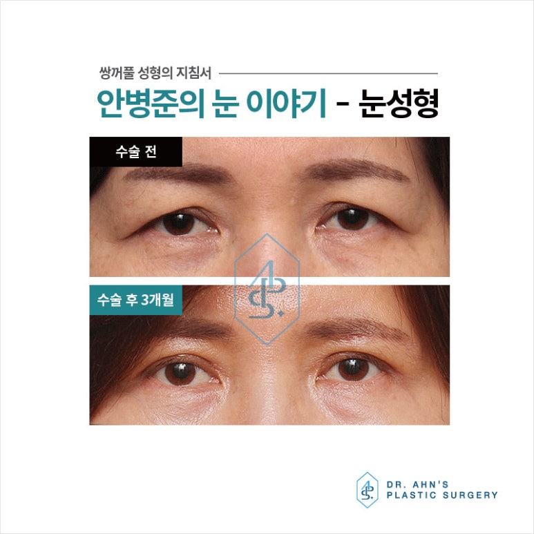 [눈성형] 쌍꺼풀수술을 선택하는 3가지 이유는?? 관련 이미지 2