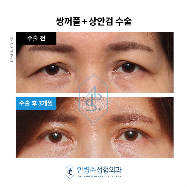 눈꺼풀 처짐 개선을 위한 수술, 어떤 방법이 있을까? 관련 이미지 1