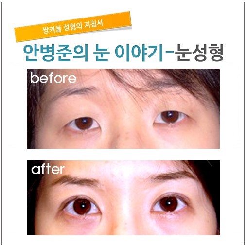 수술후 1개월     [안병준의 눈이야기] 관련 이미지 1