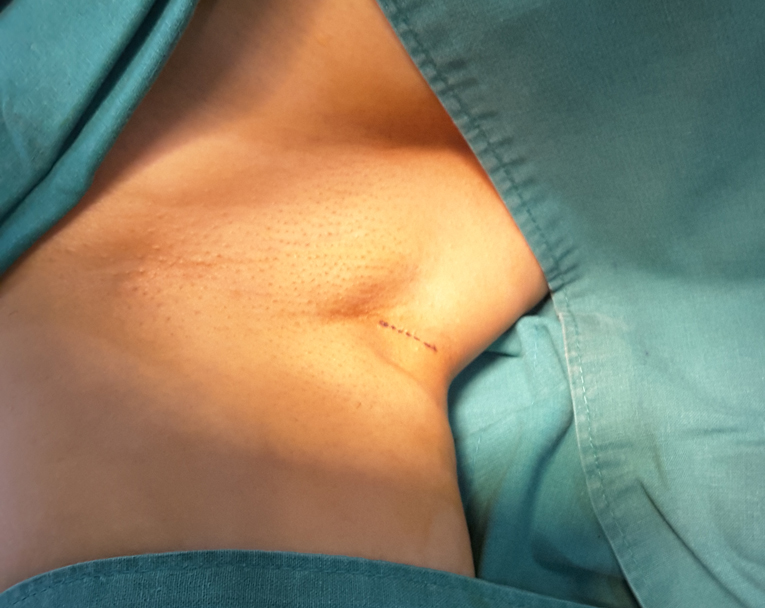 효과 좋은 지방이식 방법 관련 이미지 4