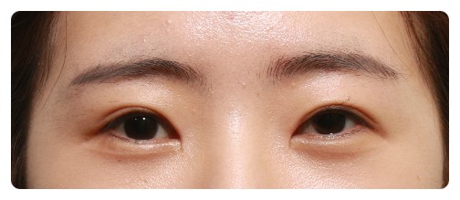 (안검하수)쌍꺼풀,눈매교정,앞트임        [안병준의 눈이야기] 관련 이미지 2