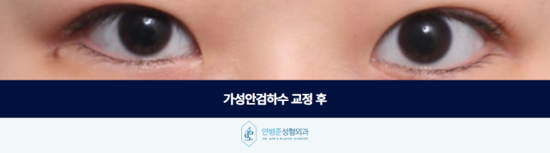 가성안검하수 알고보면 이 부분이 원인일 수 있습니다 관련 이미지 3