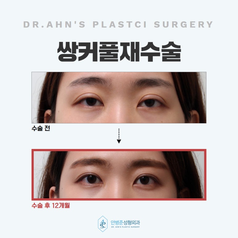 쌍꺼풀재수술 잃어버렸던 자연스러운 눈을 찾아서 관련 이미지 5