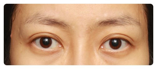 (재수술)높은라인의 쌍꺼풀 재수술      [안병준의 눈이야기] 관련 이미지 1