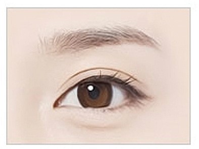 안병준의 쌍꺼풀 지침서 10 _ 쌍꺼풀 라인의 유형(인라인과 아웃라인) 관련 이미지 2