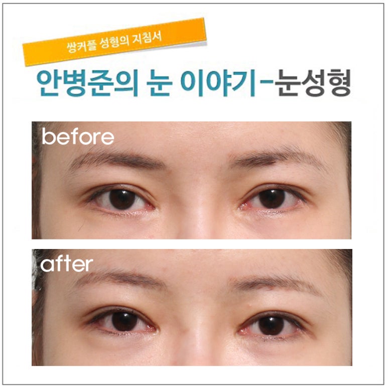 4번째 재수술(쌍꺼풀수술 흉터제거,재수술) 관련 이미지 1