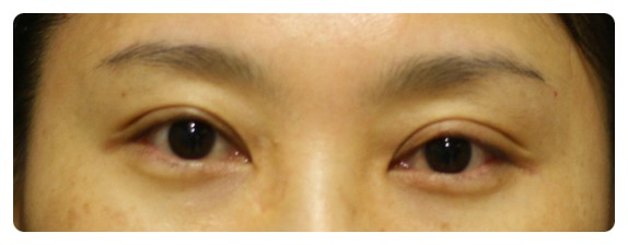 -소시지눈 고치기 과정-        [안병준의 눈이야기] 관련 이미지 1