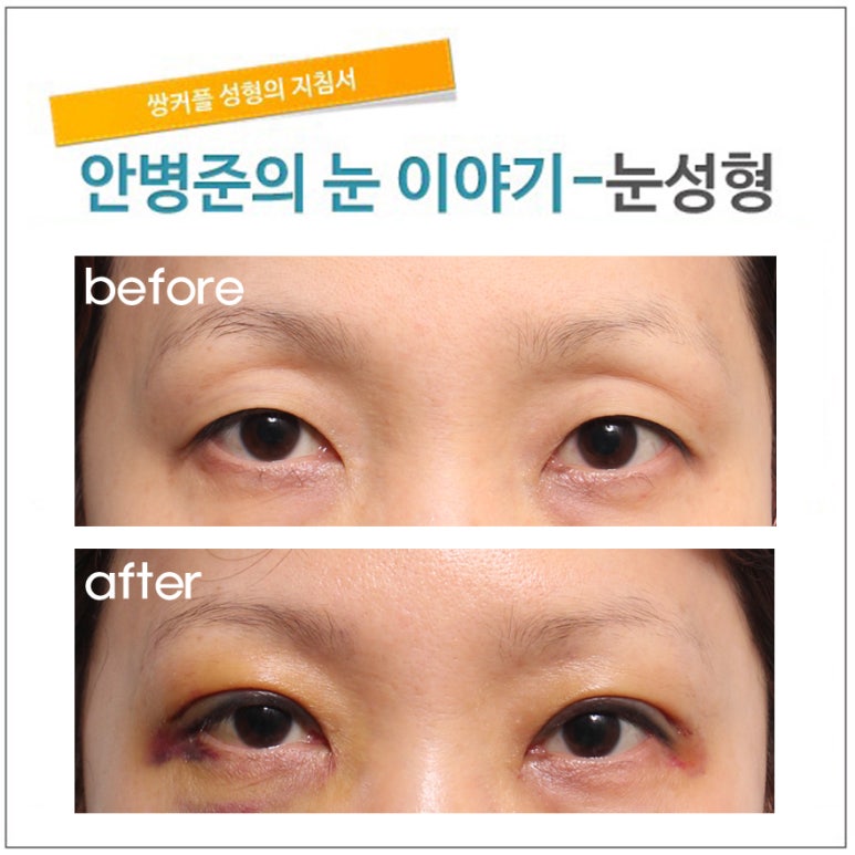쌍꺼풀,눈매교정,지방이식(꺼진 눈) 관련 이미지 1