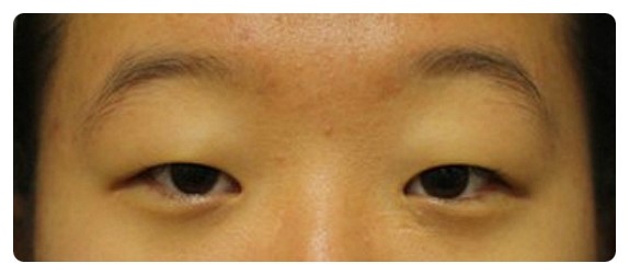 진짜 안검하수와 가짜 안검하수.(안검하수) 관련 이미지 4