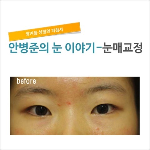 실밥 제거 후.   [안병준의 눈이야기] 관련 이미지 1