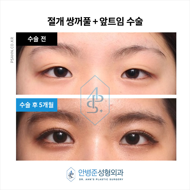 [방배역성형외과]쌍꺼풀 앞트임,나에게 맞는 방법은? 관련 이미지 2