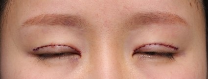 흉터와 라인줄이기 관련 이미지 3