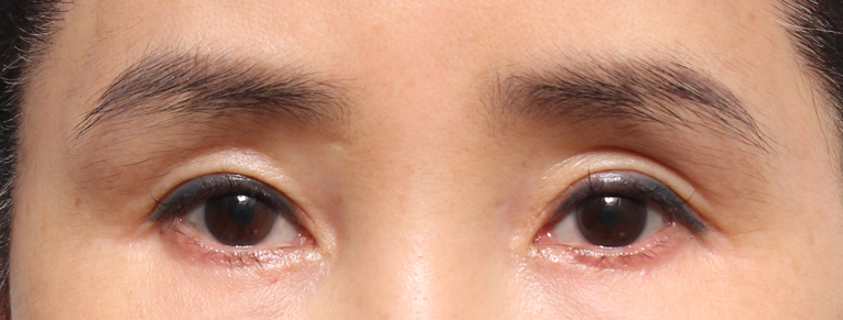 효과 좋은 지방이식 방법 관련 이미지 2