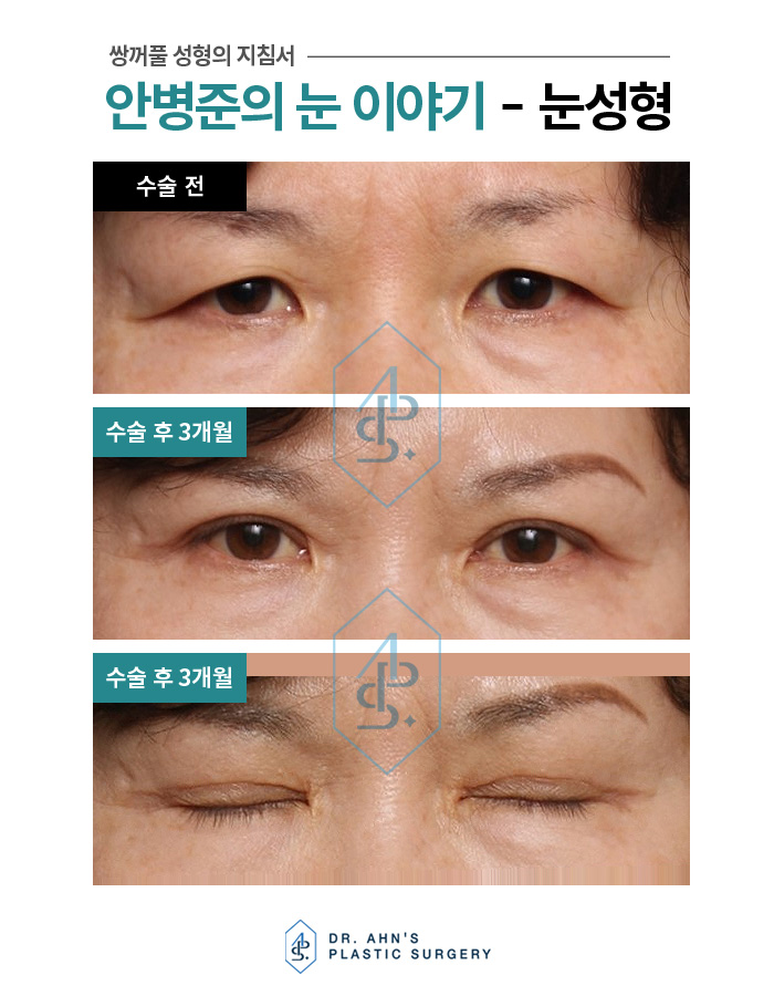 처진눈의 기능 및 미용 안검 상안검수술 3개월 사례 관련 이미지 2