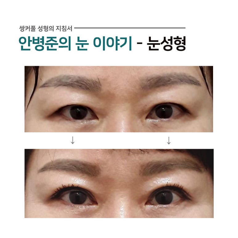 상안검성형술(상안검,지방재배치) 관련 이미지 1