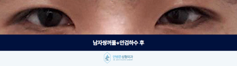 남자쌍꺼풀 안검하수 졸려 보이는 인상 눈 뜨는 힘부터 확인해야 합니다 관련 이미지 3