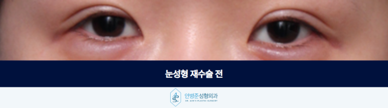 What You Should Check Before Rushing to a Ptosis Diagnosis in Revision Eye Surgery image 2