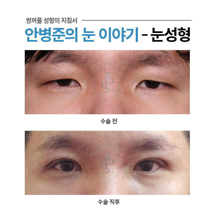 쌍꺼풀 수술에서 부기란? - 수술직후 붓기 사례 모음 관련 이미지 5