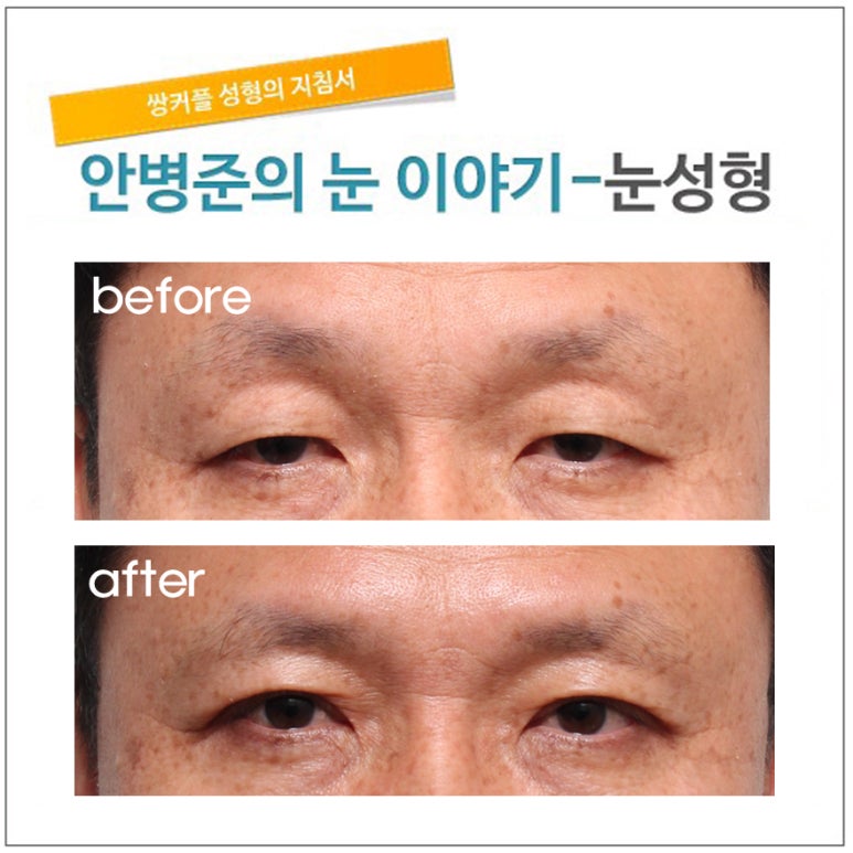 처진 피부와 경미한 안검하수(피부절제,눈매교정) 관련 이미지 1