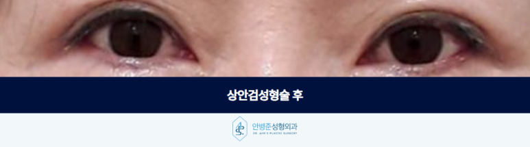 상안검성형술 눈꺼풀 처짐이 심하다면 이것까지 고려해야 합니다 관련 이미지 3