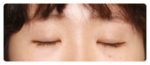 쌍꺼풀,눈매교정 10개월후.         [안병준의 눈이야기] 관련 이미지 3