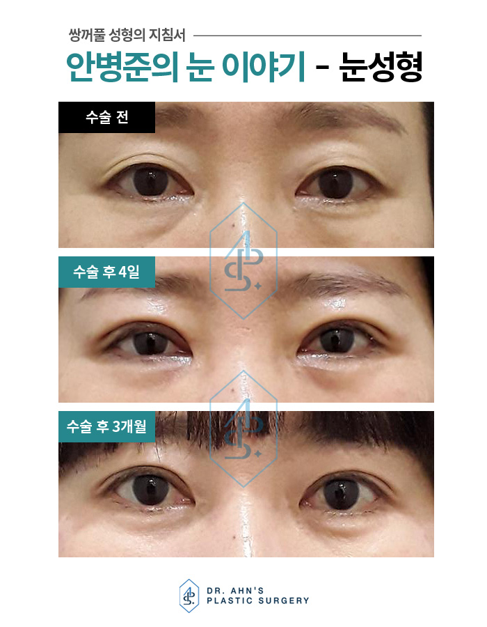 [강남역성형외과] 상안검,하안검 수술의 숨겨진 비밀 관련 이미지 1
