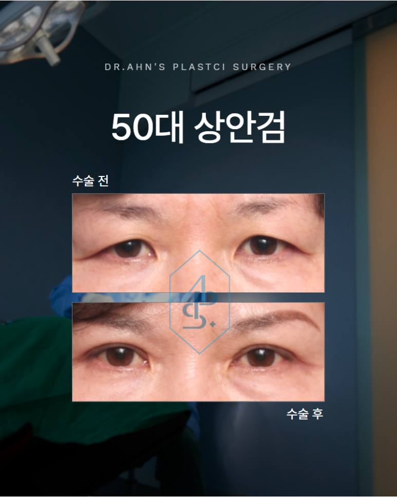 50대 상안검 나이들수록 처진 눈꺼풀이 콤플렉스로 다가온다면 관련 이미지 1