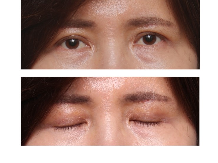 상안검성형술과 눈썹밑 절개술 관련 이미지 3