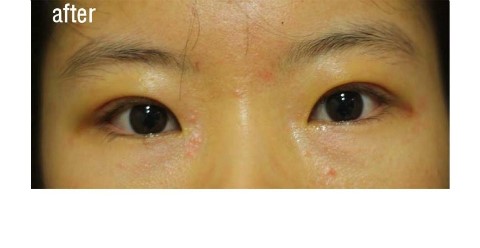 실밥 제거 후.   [안병준의 눈이야기] 관련 이미지 2