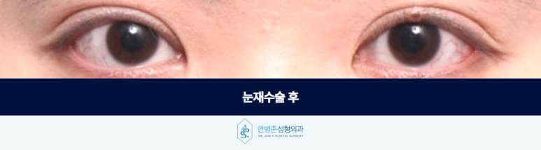 눈재수술성형외과 여러 번 수술 후에도 남아있는 고민이라면 관련 이미지 3