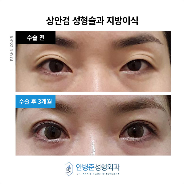 [방배역 안병준성형외과] 상안검성형술과 지방이식 관련 이미지 2