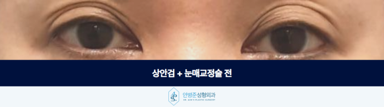 상안검 수술 눈매교정술 함께 정리해야 하는 경우가 있습니다 관련 이미지 2