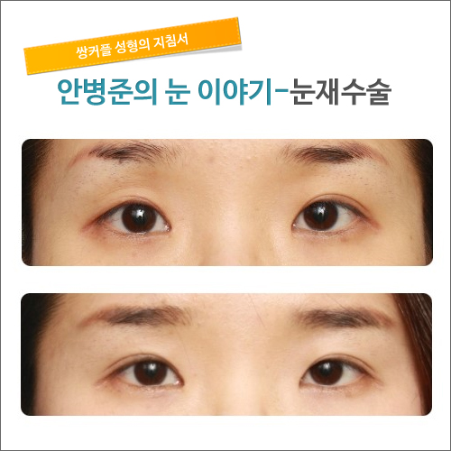 눈재수술 눈성형잘하는병원 시크릿성형외과 관련 이미지 1